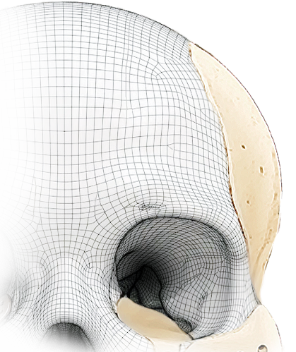 Cranial implant upper right