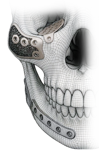 Cranial implant bottom left